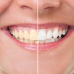 Close up of a smile with half showing the benefits of professional teeth whitening.