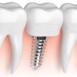 closeup of a dental implant under the gums to replace a missing tooth in Monroe, WA