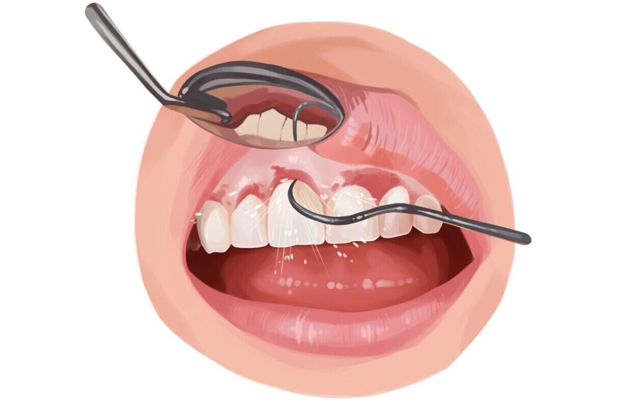 Drawing of a patient receiving scaling and planing procedure to treat gum disease