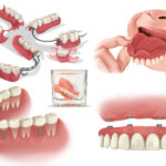 Illustrations of different configurations of dentures to replace missing teeth