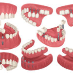 Illustration of various configurations of dental implants to replace missing teeth